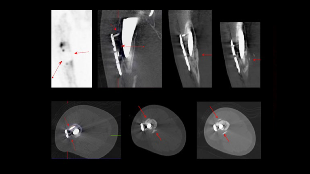 SPECT/CT delineation of proximal screw loosening and distal ...