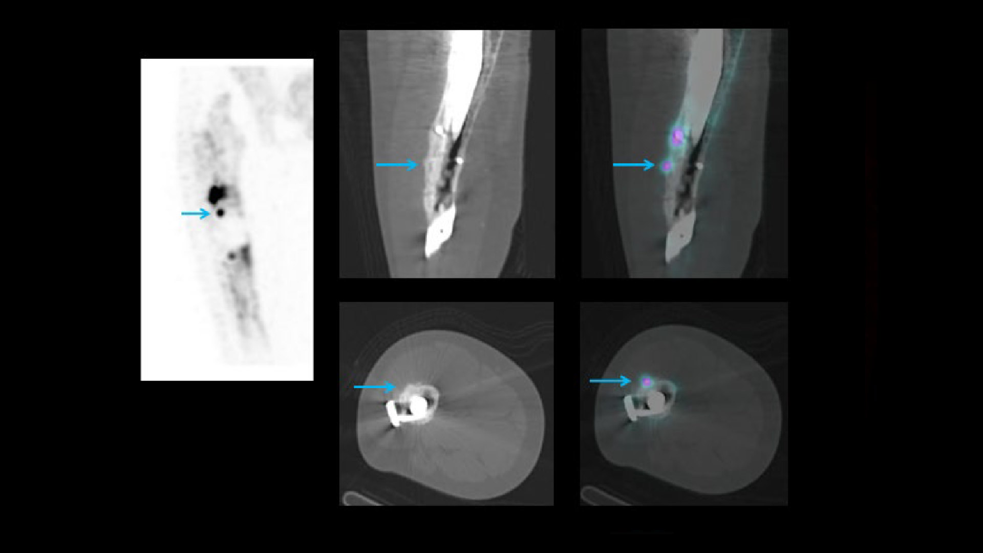 SPECT/CT delineation of proximal screw loosening and distal ...