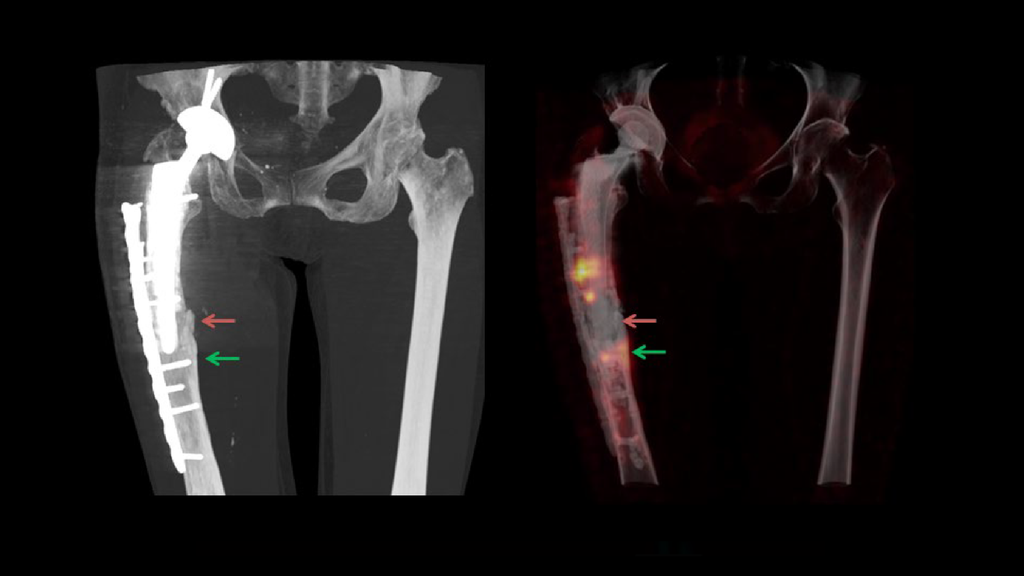 SPECT/CT delineation of proximal screw loosening and distal