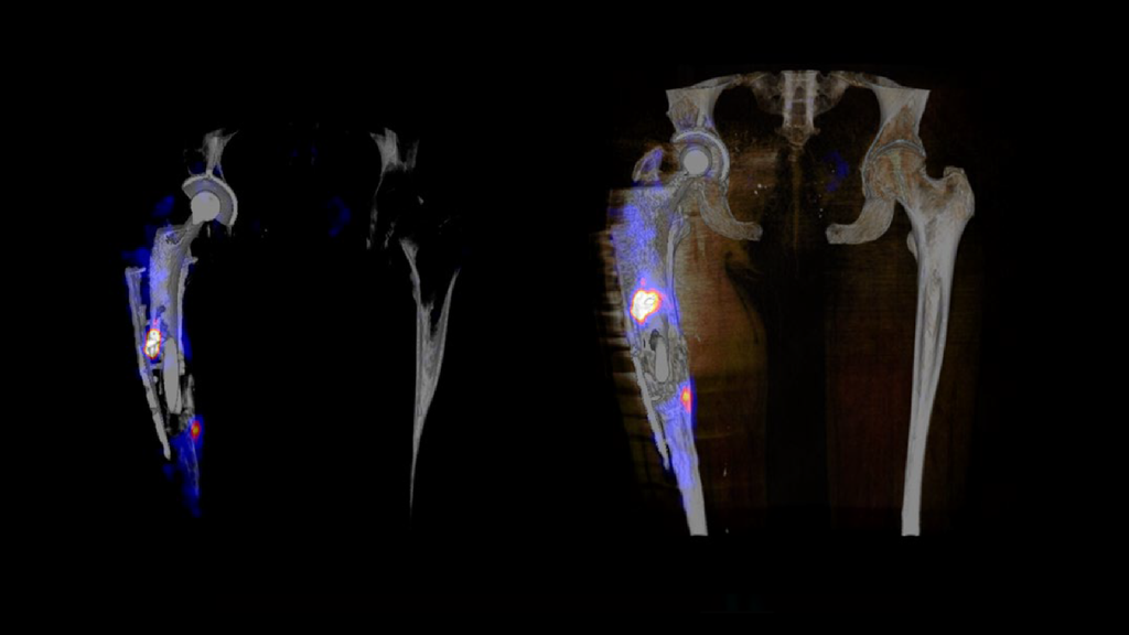 SPECT/CT delineation of proximal screw loosening and distal ...