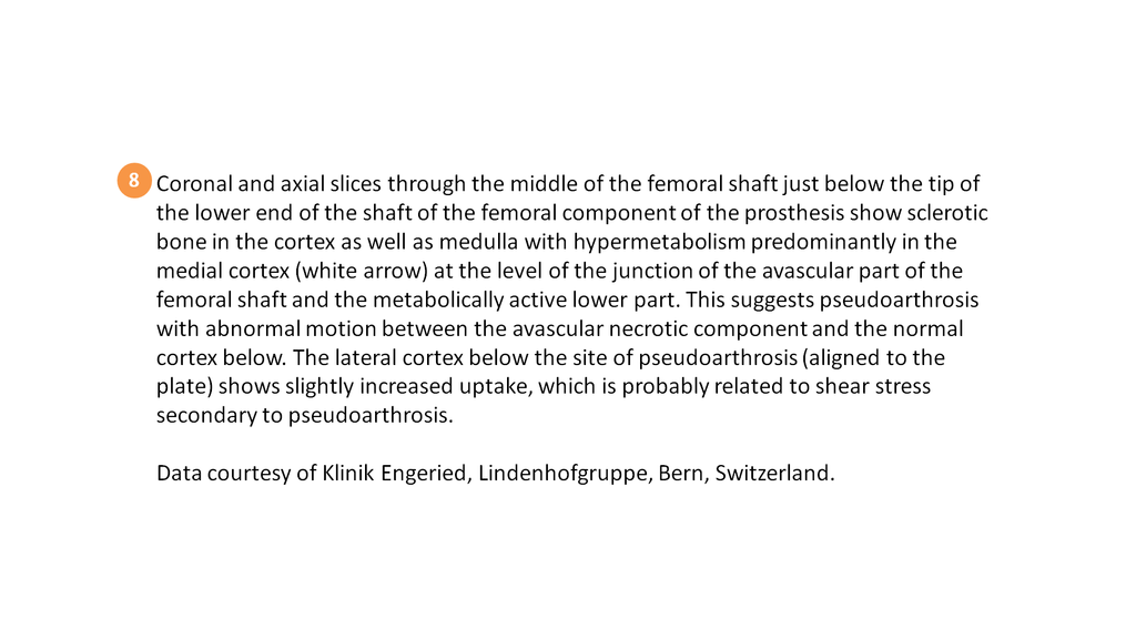 SPECT/CT delineation of proximal screw loosening and distal ...