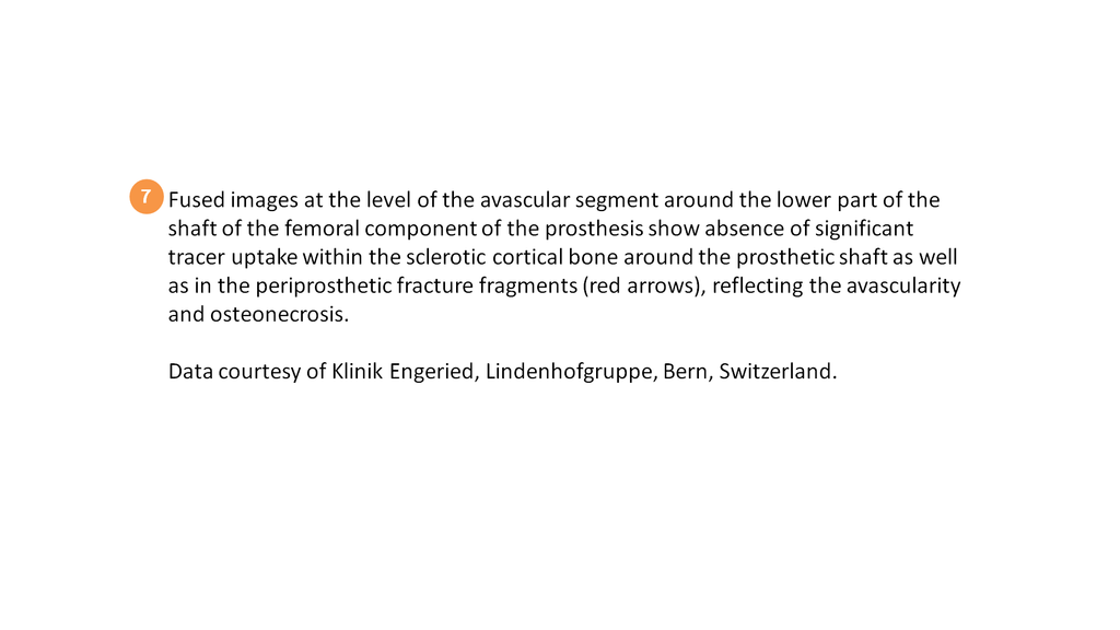 SPECT/CT delineation of proximal screw loosening and distal ...