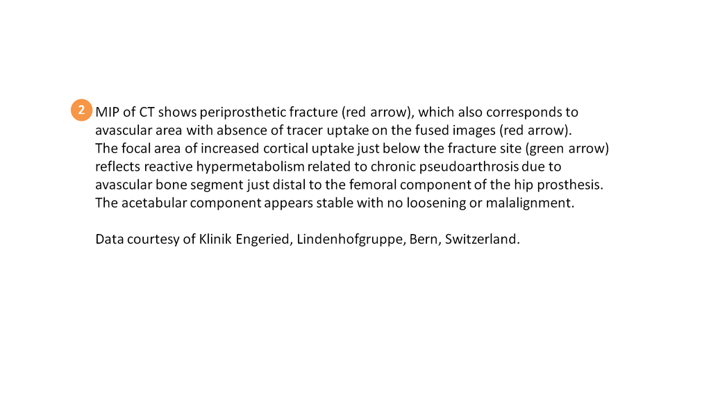 SPECT/CT delineation of proximal screw loosening and distal ...