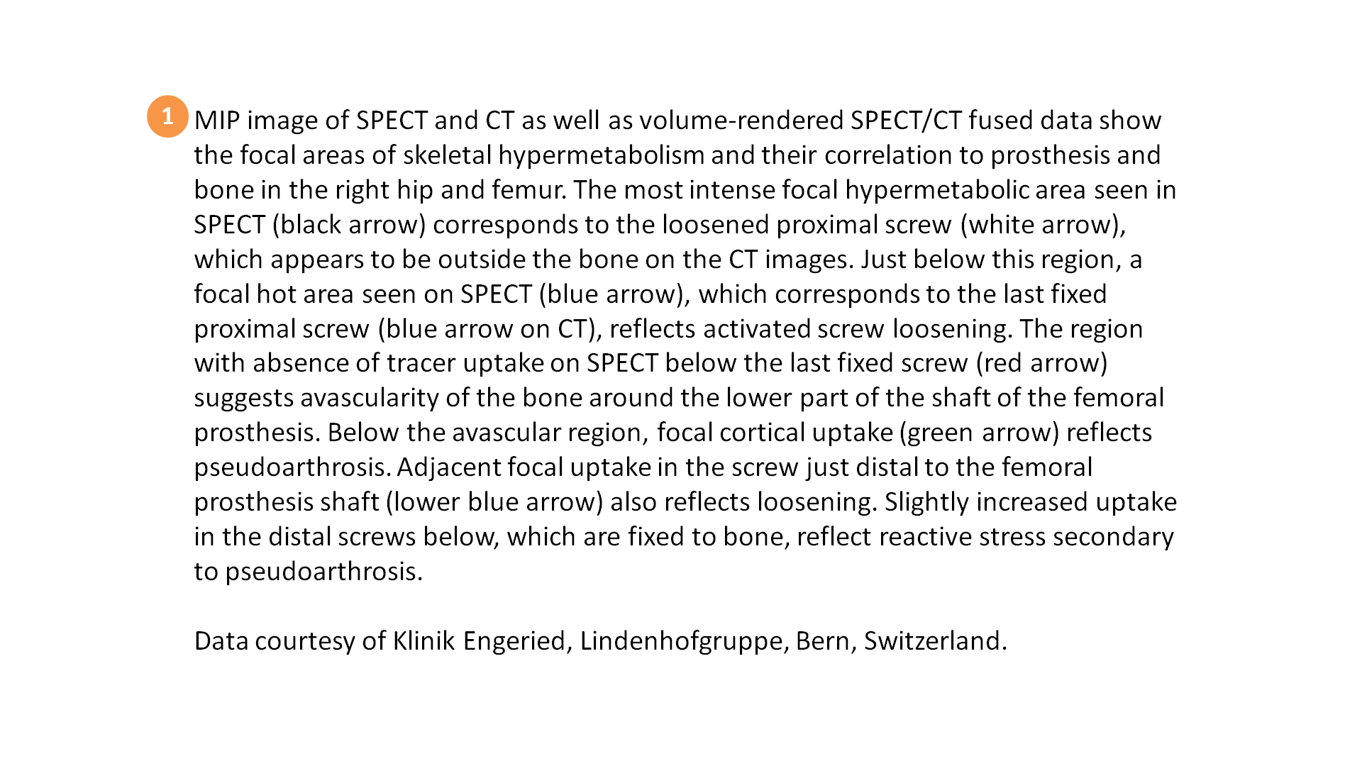 SPECT/CT delineation of proximal screw loosening and distal ...