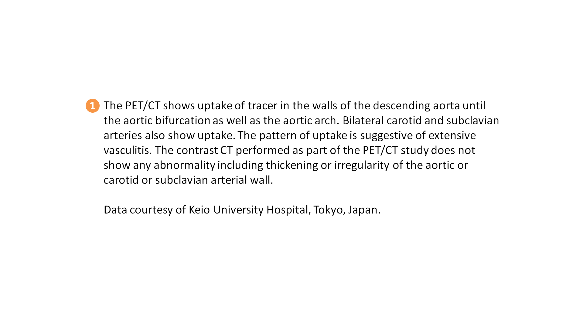 PET/CT Detection Of Temporal Arteritis Siemens Healthineers