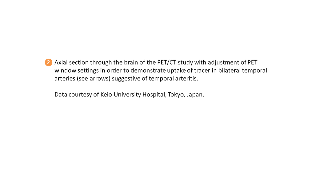 PET/CT Detection Of Temporal Arteritis Siemens Healthineers
