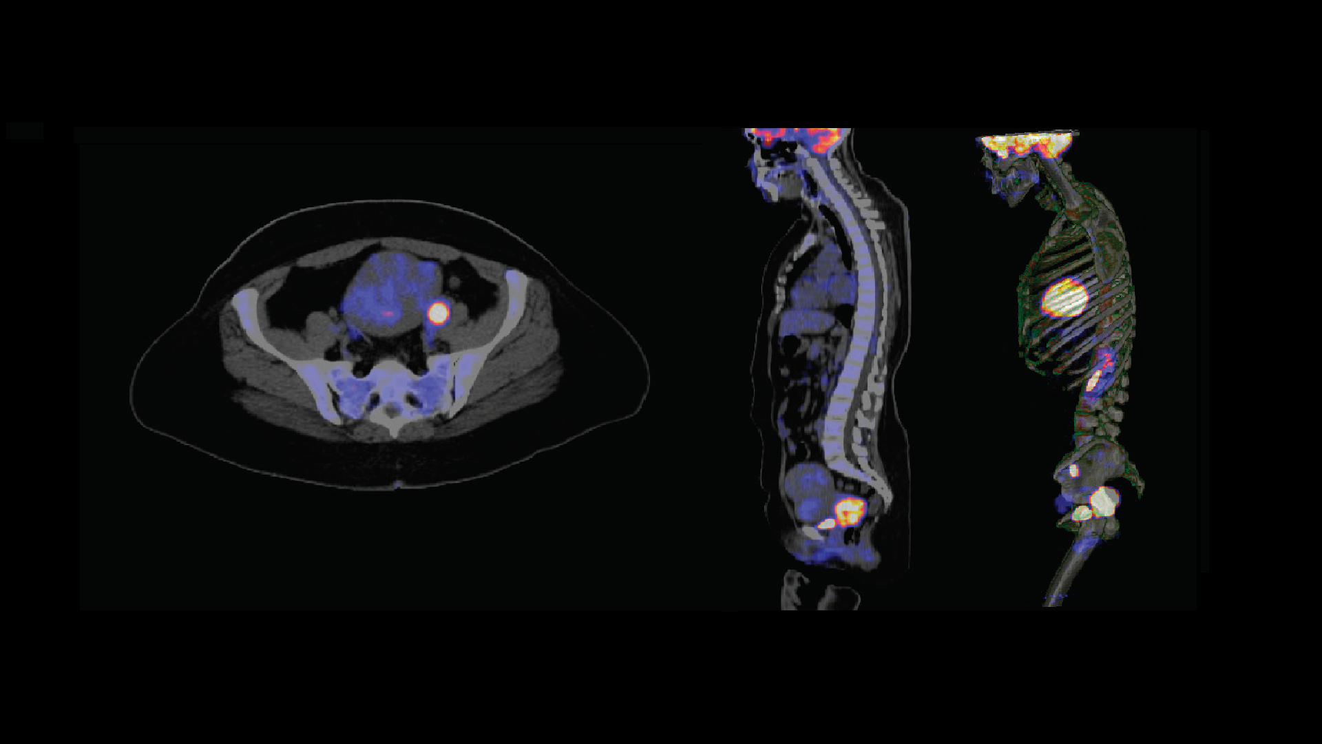 FDG PET/CT and cervical cancer - Siemens Healthineers