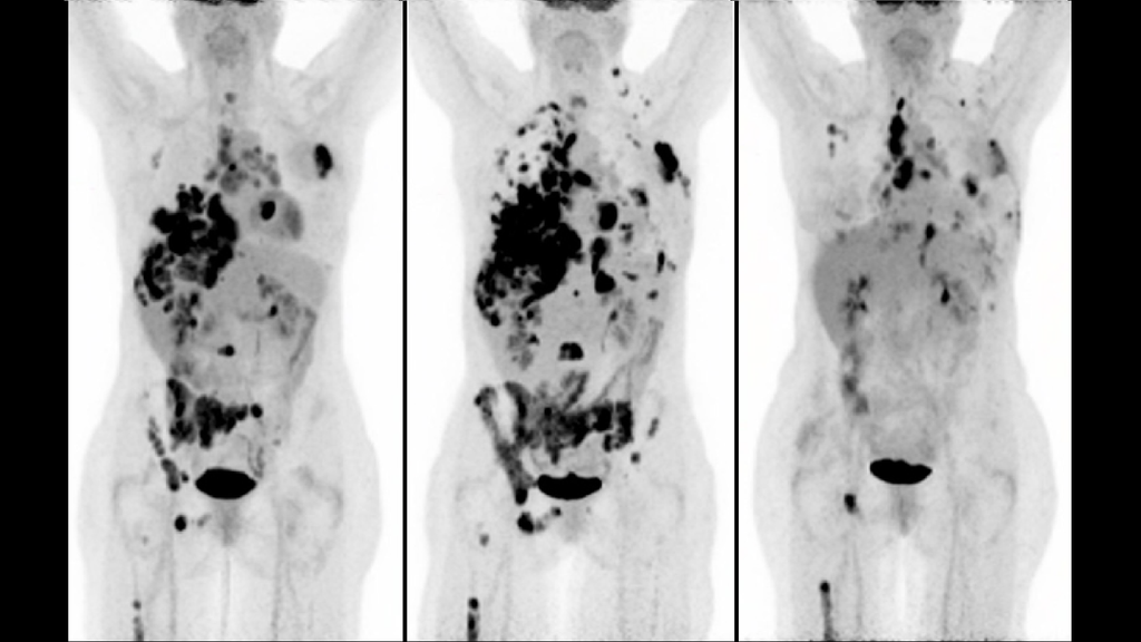 The value of PET/CT for melanoma - Siemens Healthineers