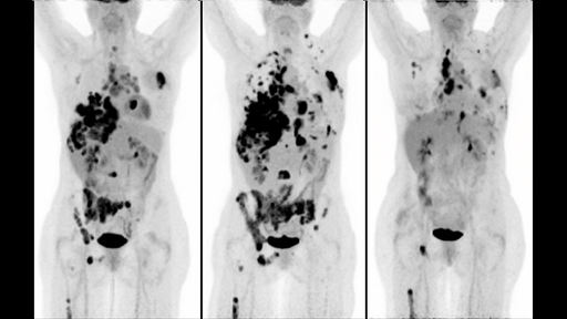 The value of PET/CT for melanoma - Siemens Healthineers USA