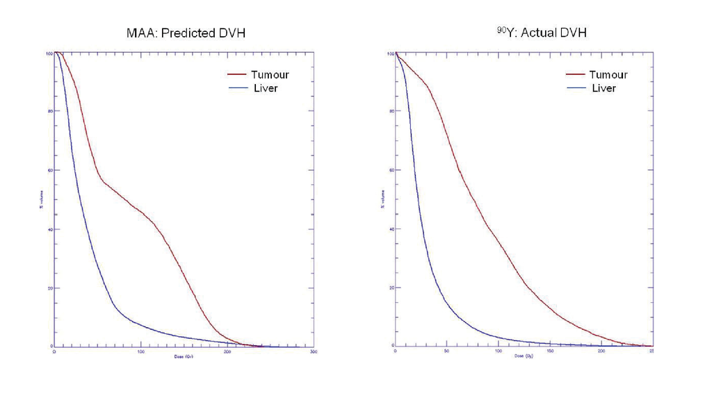 Quantitative SPECT imaging of hepato-pulmonary shunting prior to SIR ...