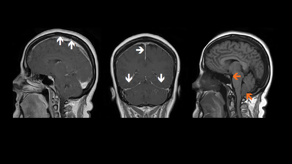 Nuclear cisternography in the detection of CSF leak Siemens Healthineers