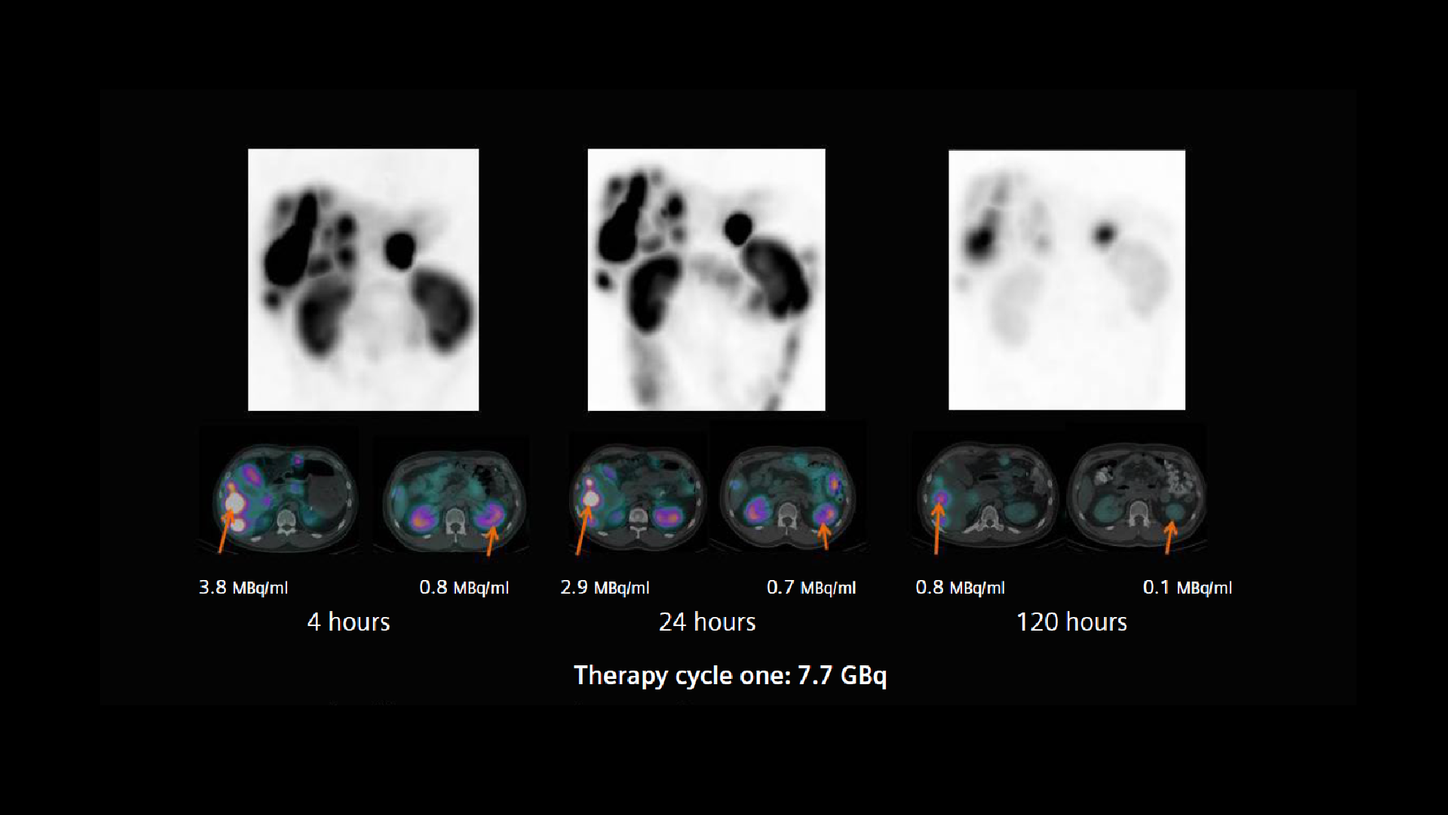 Maximum intensity projection (MIP) and fused SPECT/CT images of the xSPECT Quant study