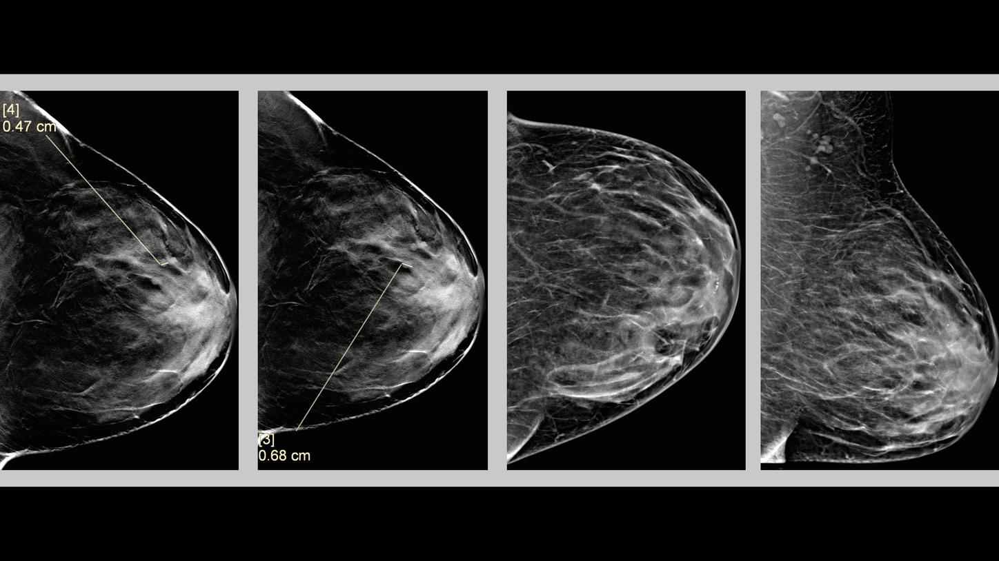 Clinical Evidence &ndash; Tomosynthesis - Case 3