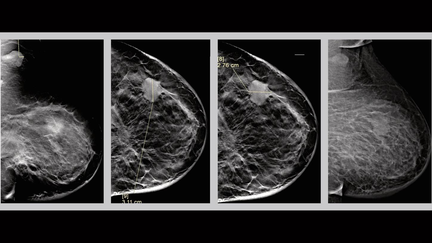 Clinical Evidence &ndash; Tomosynthesis - Case 1