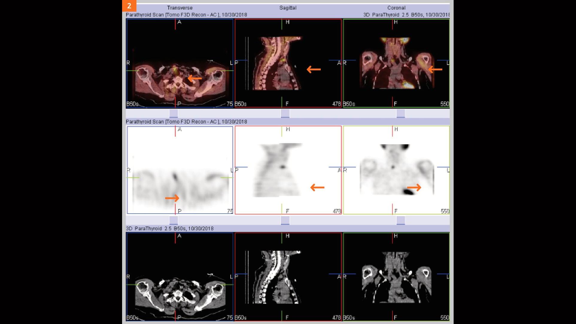Ectopic parathyroid adenoma diagnosed by SPECT-CT imaging using 99mTc-MIBI