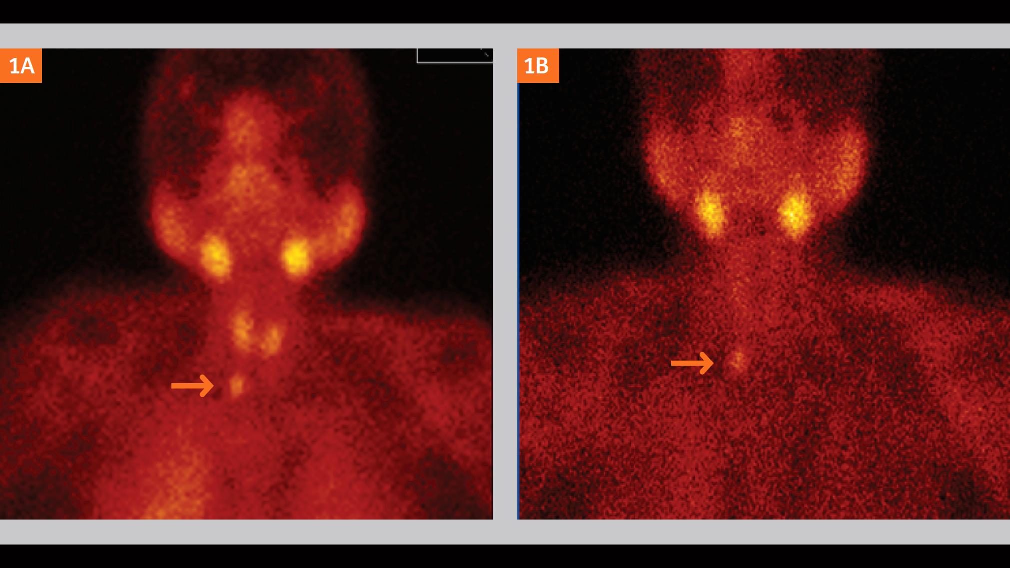 Ectopic parathyroid adenoma diagnosed by SPECT-CT imaging using 99mTc-MIBI