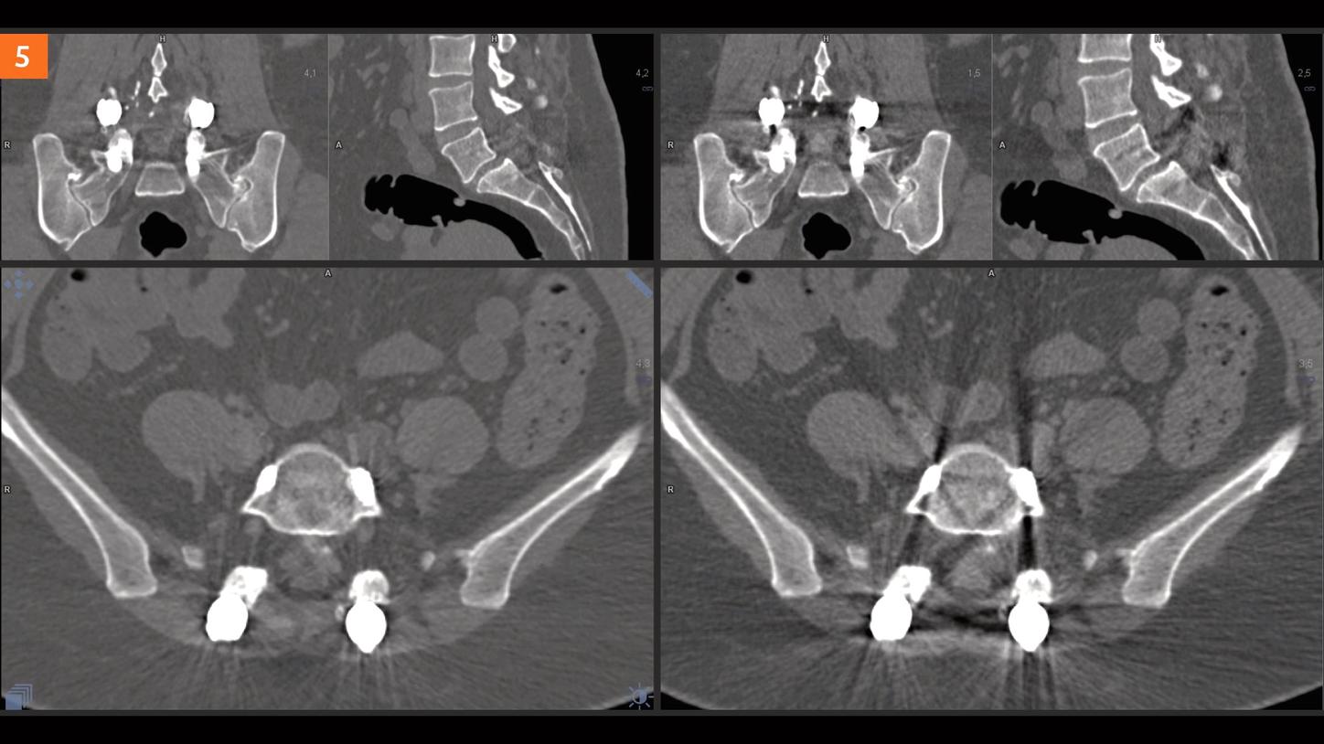 SOMATOM go.Top Experience with iMAR
