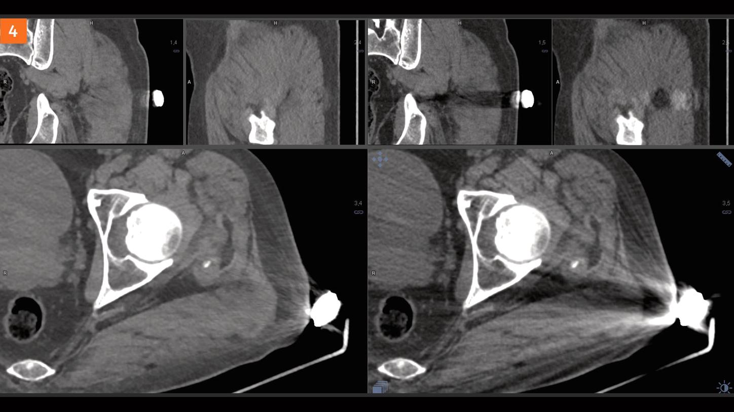 SOMATOM go.Top Experience with iMAR