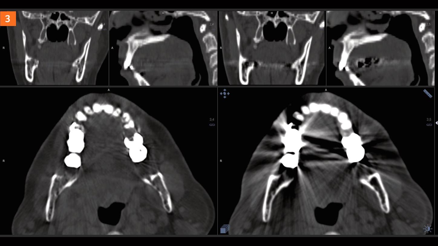 SOMATOM go.Top Experience with iMAR