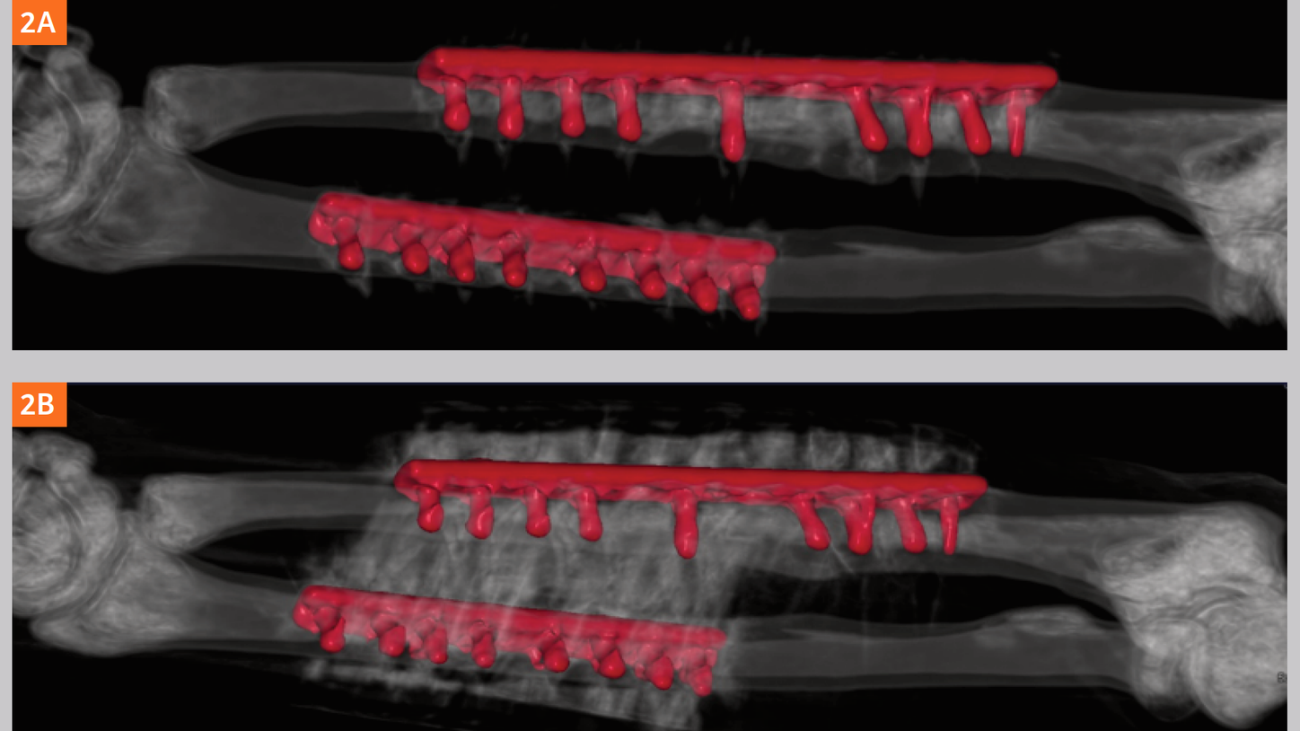 SOMATOM go.Top Experience with iMAR (iterative metal artifact reduction)