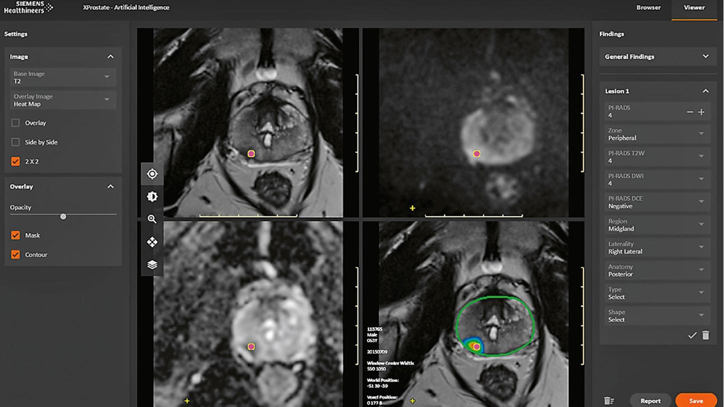 Figure 3: Prototype for AI evaluation of multiparametric prostate MRI