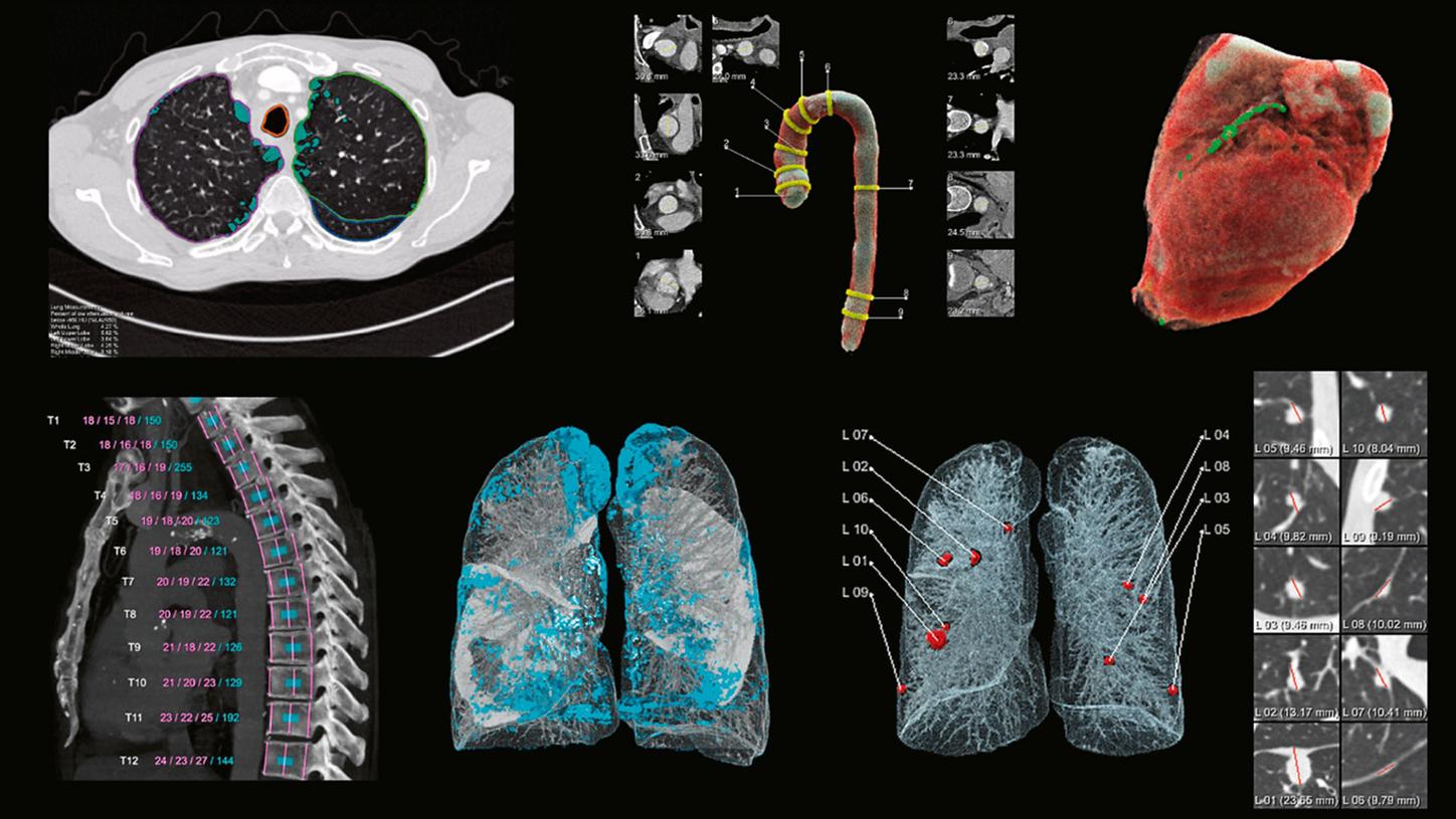 Figure 2: Chest CT results from the AI-Rad Companion platform