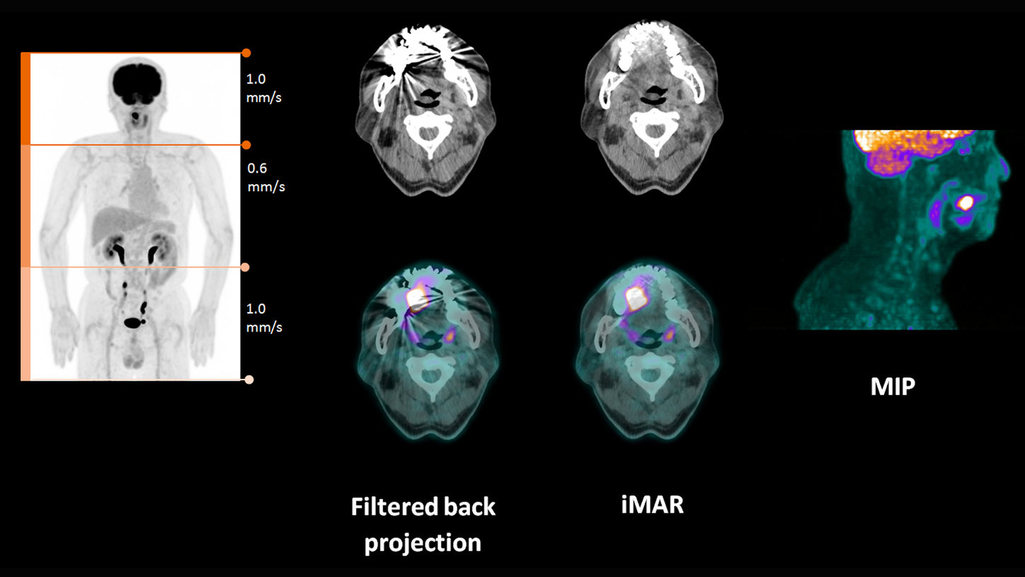 Head scans taken using iMAR on Biograph Horizon.