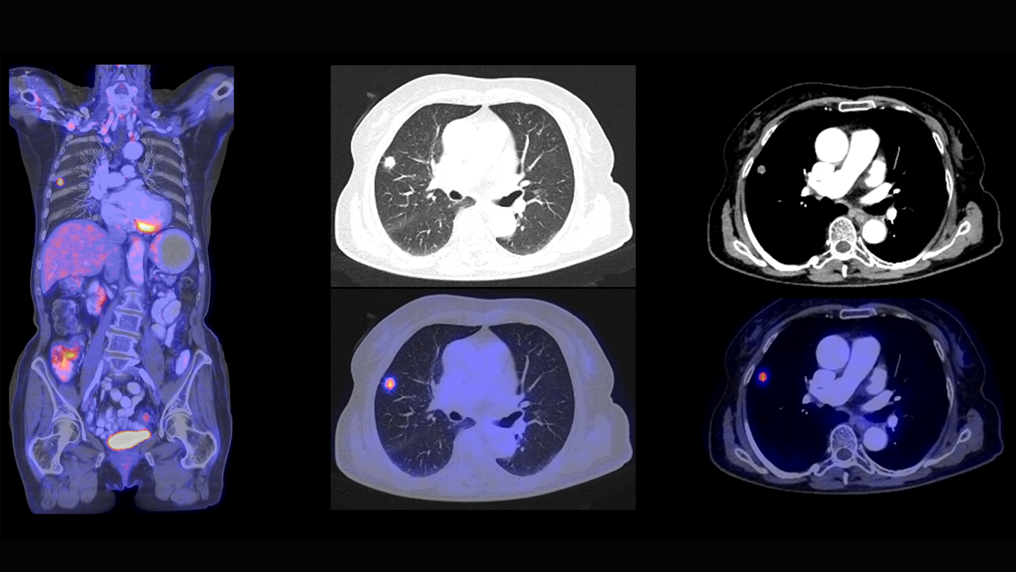 Biograph Horizon lung scan using SAFIRE.