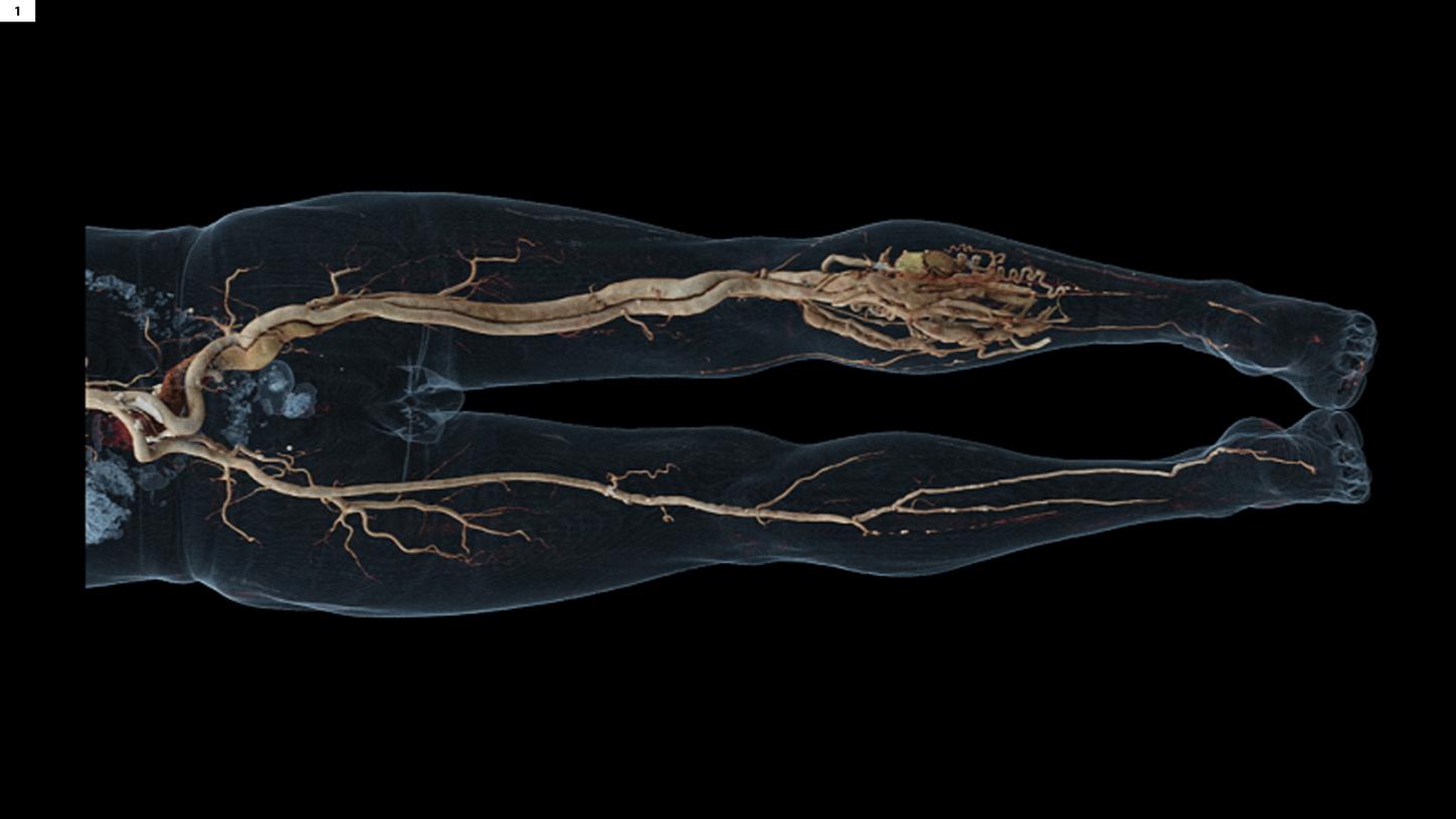 A Runoff CT angiography was requested to evaluate long-term pain in lower limb of a 67-year old male patient.