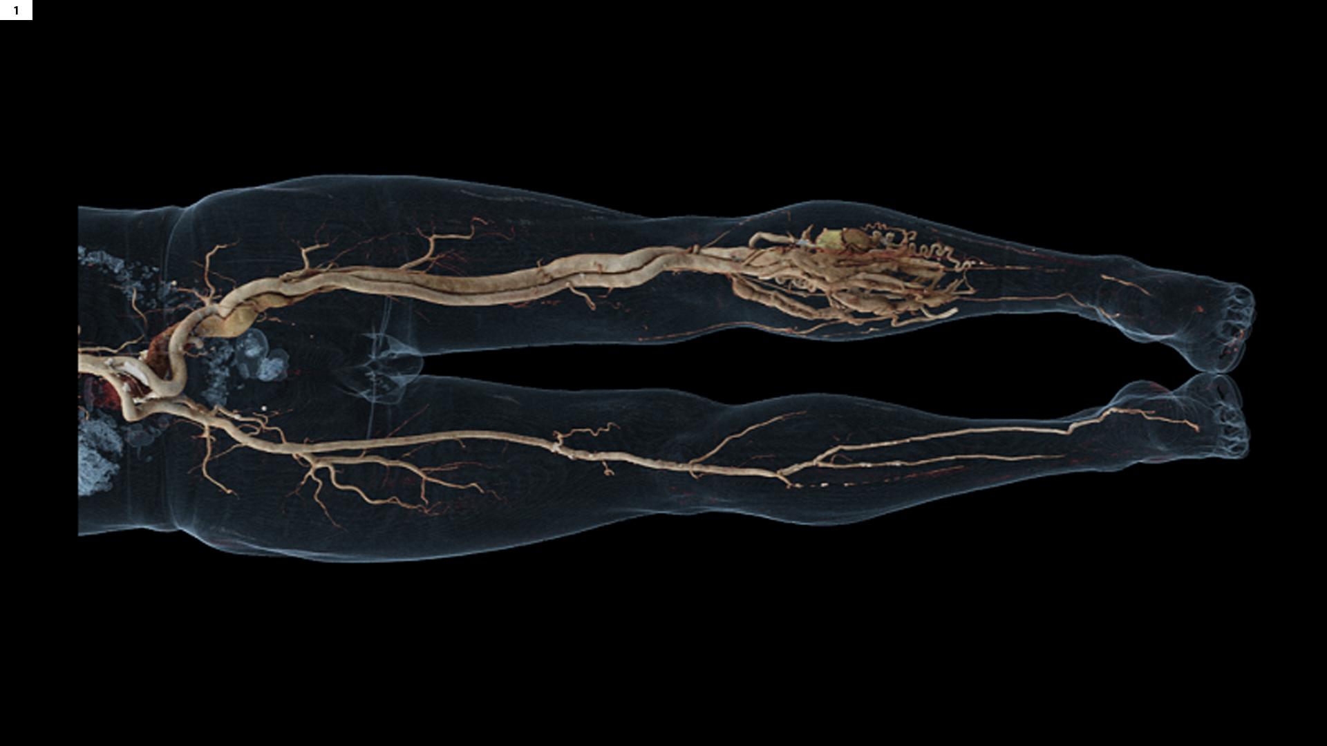 Arteriovenous Malformation of the Left Lower Limb - Siemens ...