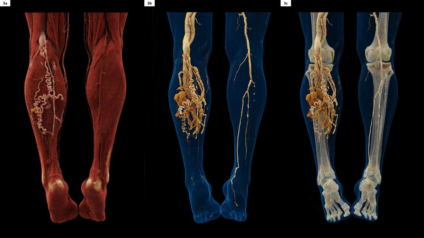 A Runoff CT angiography was requested to evaluate long-term pain in lower limb of a 67-year old male patient.