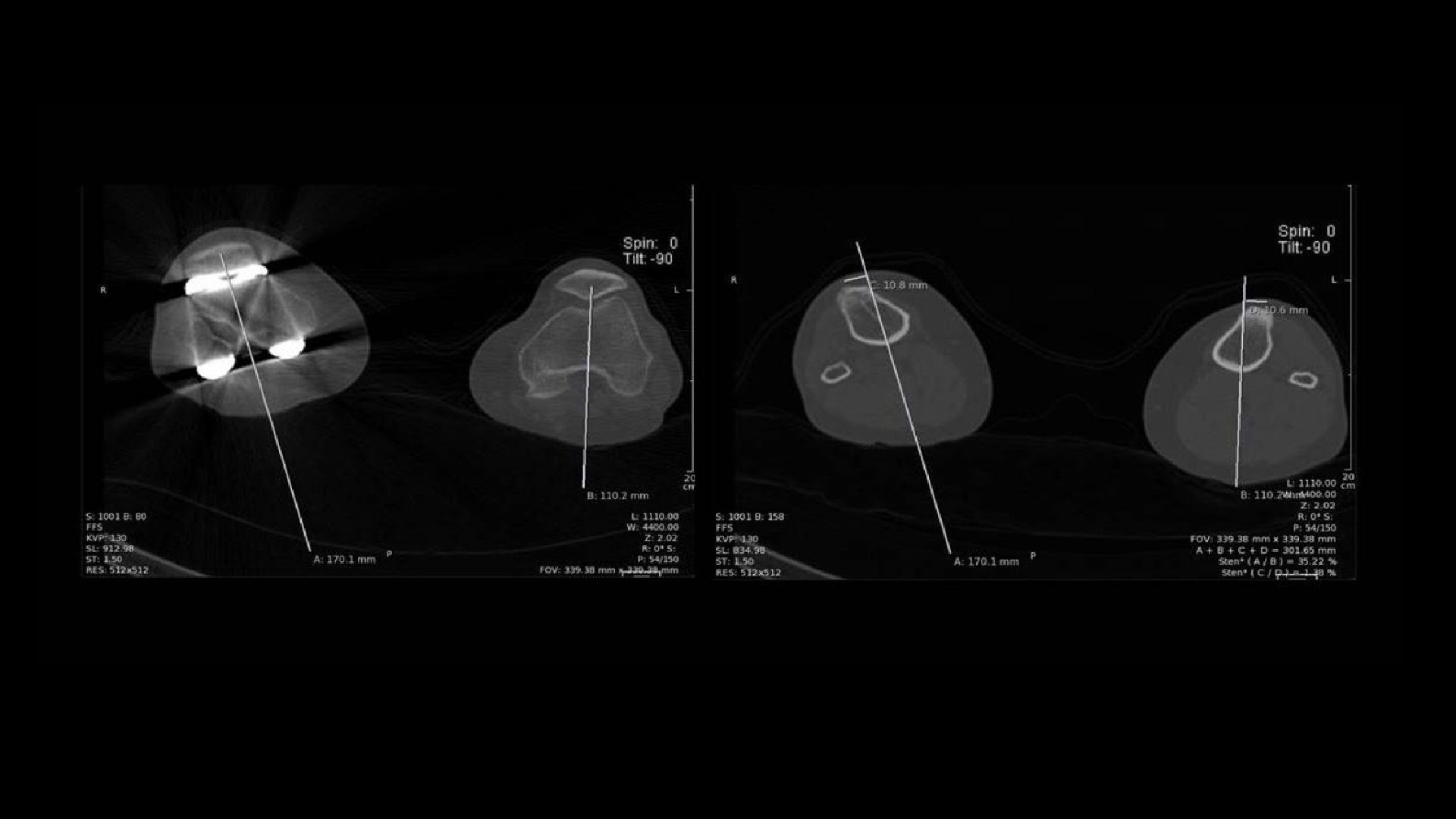 SPECT/CT delineation of patellar and femorotibial overload after knee ...