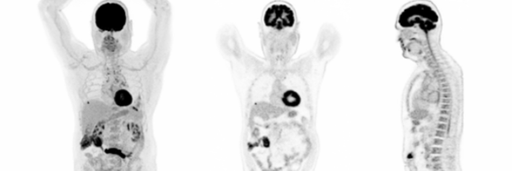 Patient story: Cardiac PET/CT reveals clinical detail - Siemens ...