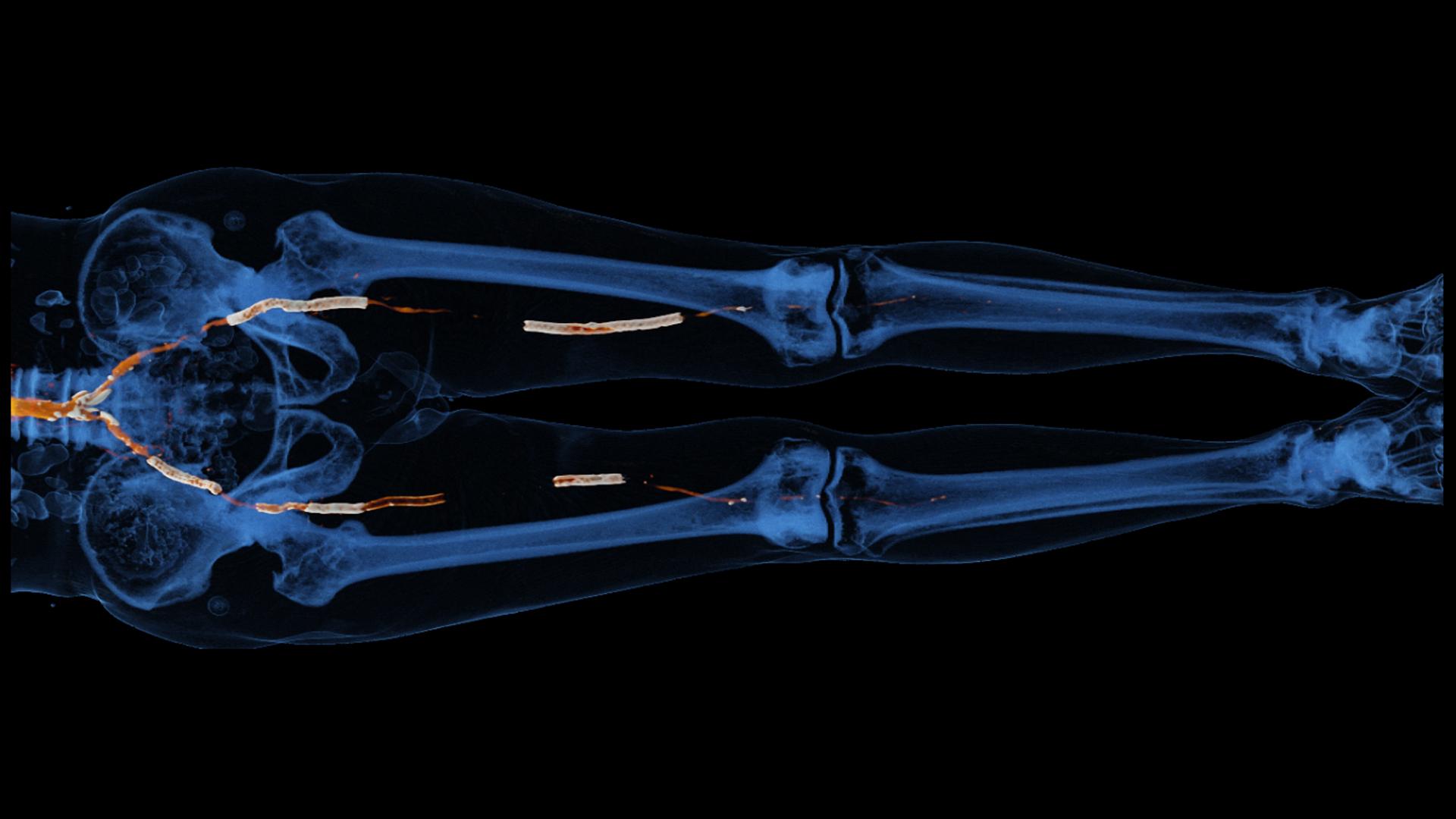 Instent Restenoses & Occlusion A Followup of Multiple Peripheral Arterial Stents Siemens