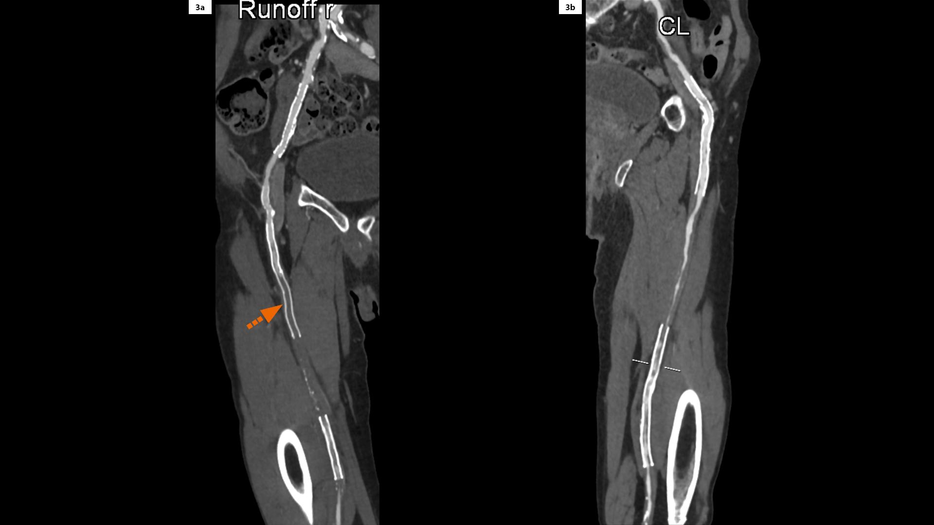 Instent Restenoses and Occlusion a followup of Multiple Peripheral Arterial Stents