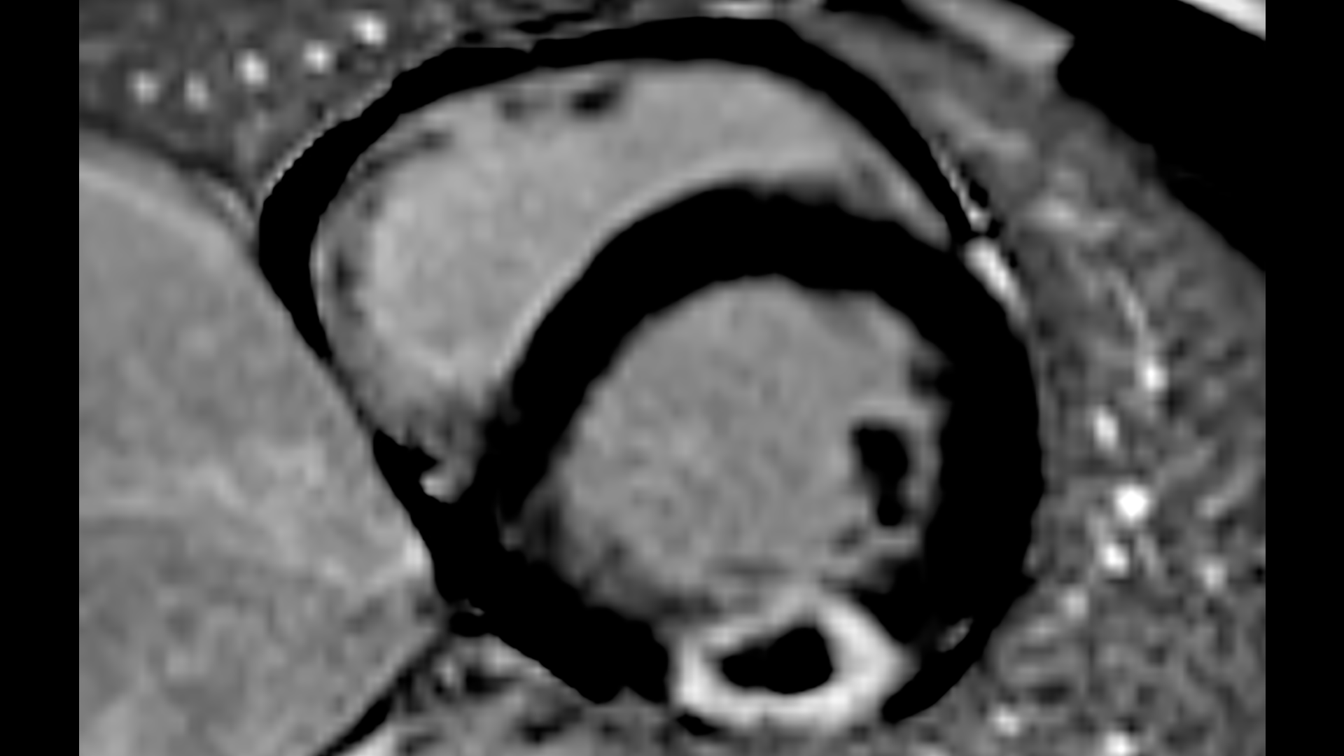 Cardiovascular MRI - Siemens Healthineers USA