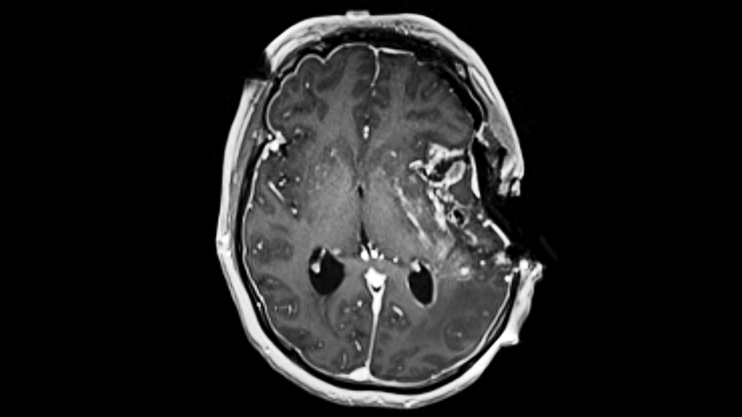 Intraoperative MR image of the head to check the results of a brain lesion resection