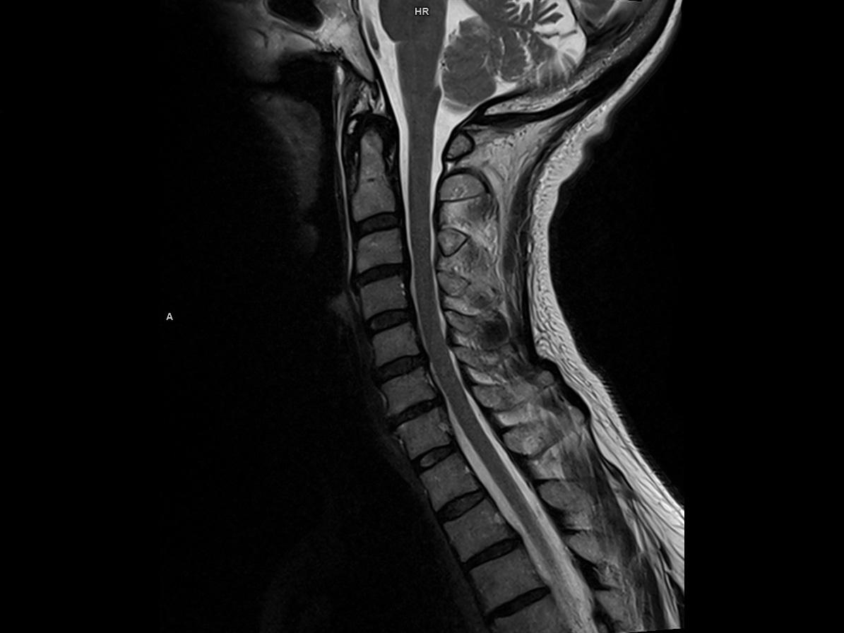 Sagittal T2 tse-MAGNETOM Altea