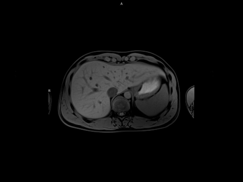 Transverse STARVIBE fs-MAGNETOM Sola