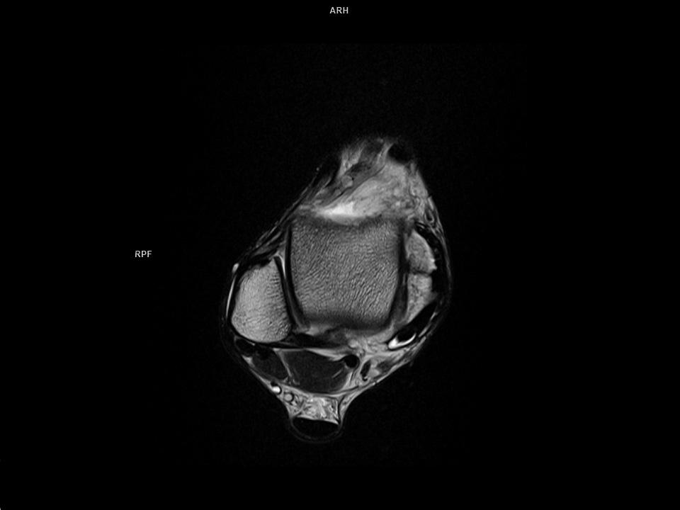 Transverse T2 tse-MAGNETOM Sola