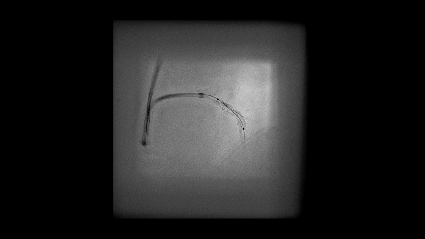 CLEARstent Live - Logiciel d'amélioration du positionnement des stents en temps réel