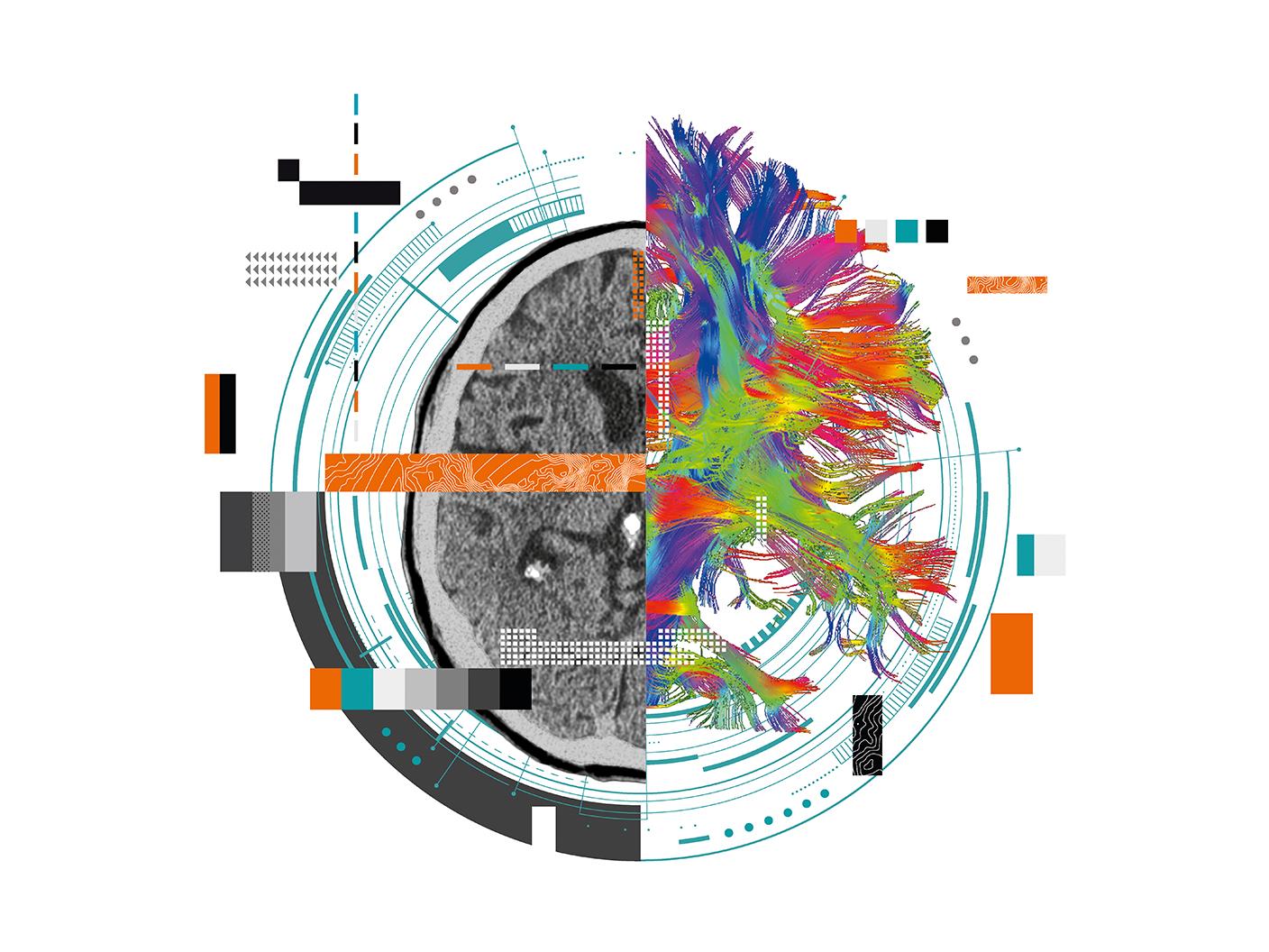 Intelligence Artificielle - AI-Rad Companion Chest CT - Siemens Healthineers