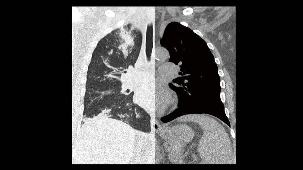 Diagnosis and treatment of lung cancer - Siemens Healthineers Finland