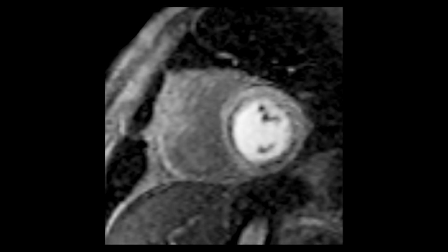 Myocardial ischemia