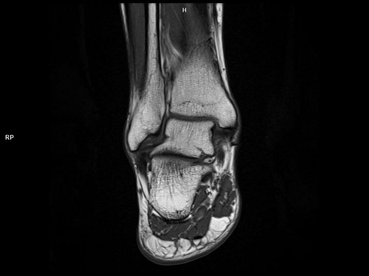 Coronal T1 TSE-MAGNETOM Lumina<br />