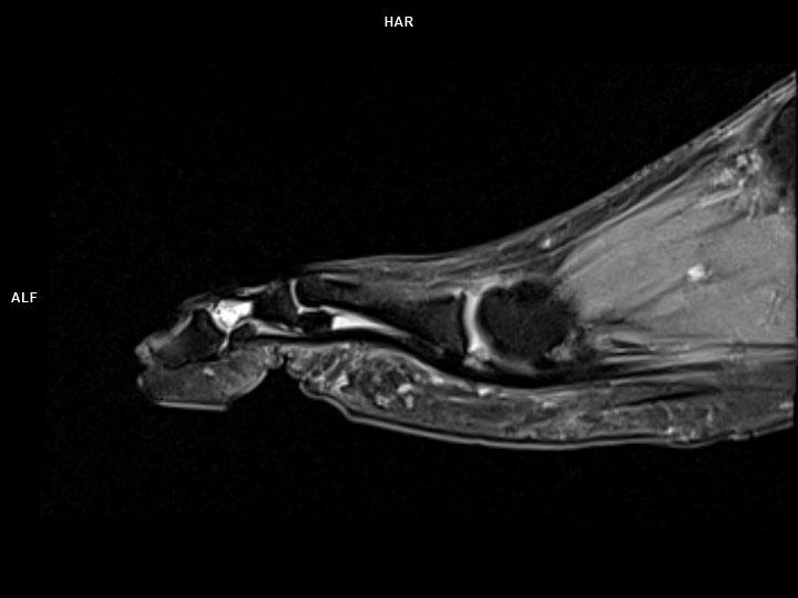 Sagittal PD FS-MAGNETOM Lumina