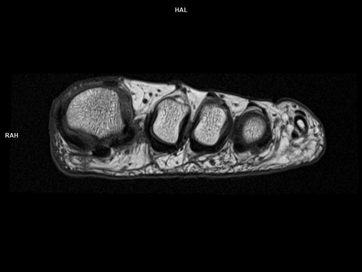 Axial T1 TSE-MAGNETOM Lumina