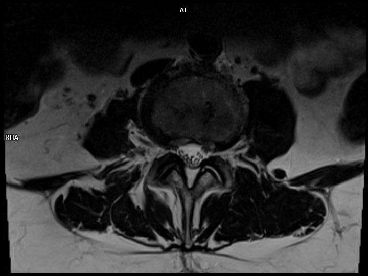 Axial T2 TSE-MAGNETOM Lumina