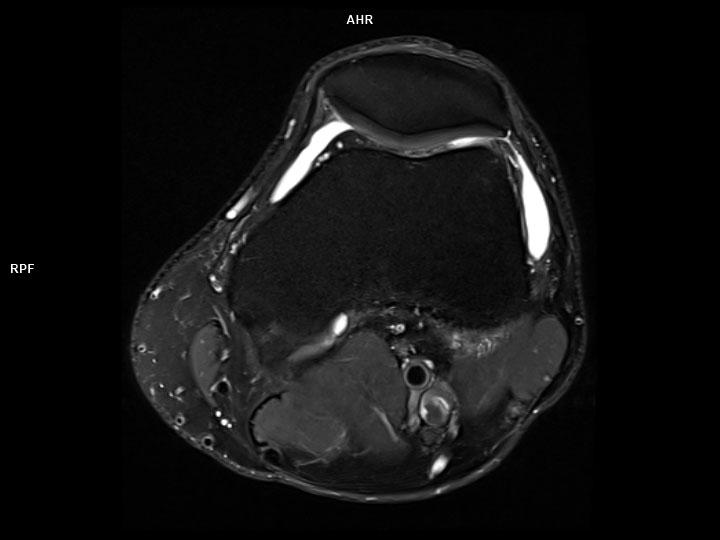 Axial PD FS-MAGNETOM Lumina