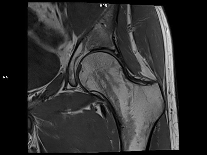 Coronal T1 TSE-MAGNETOM Lumina